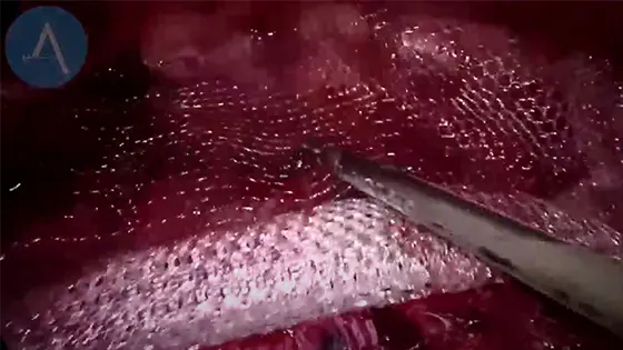 ρομποτική χειρουργική ομφαλοκήλης etep