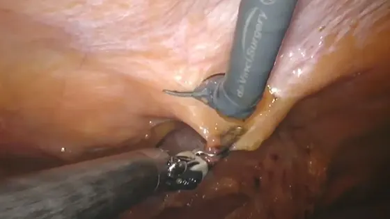 ρομποτική χειρουργική ομφαλοκήλης lira