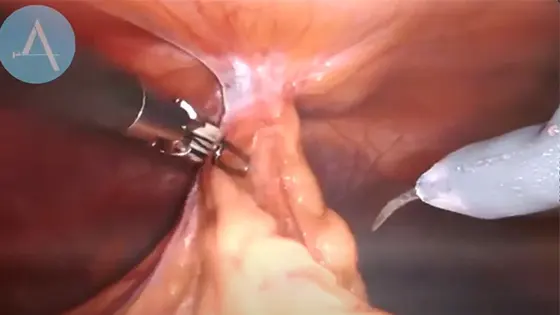 ρομποτική χειρουργική ομφαλοκήλης tapp